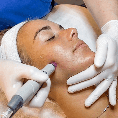 What Are The 5 Advantages Of Microdermabrasion In Dubai
