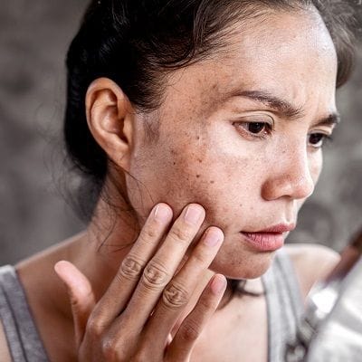 What Causes Skin Pigmentation and can it be Treated? 1 What Causes Skin Pigmentation and can it be Treated?