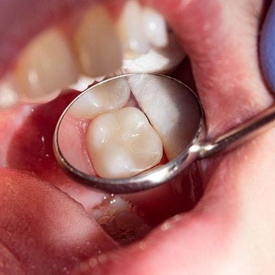 What Does A Dental Filling Do