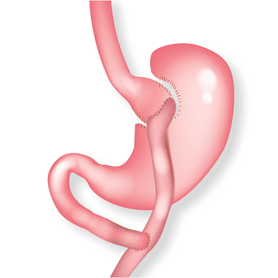 What Does Gastric Bypass Surgery Do? 1 What Does Gastric Bypass Surgery Do