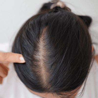 What Is Female Pattern Baldness In Dubai? 1 What Is Female Pattern Baldness In Dubai