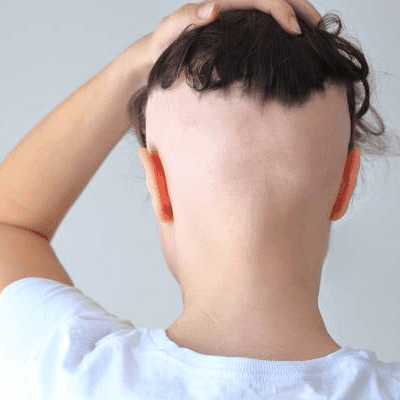 What is Frontal Fibrosing Alopecia in Dubai? 1 What Is Frontal Fibrosing Alopecia In Dubai?
