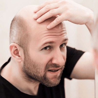 What Is The Best Solution For Male Baldness In Dubai