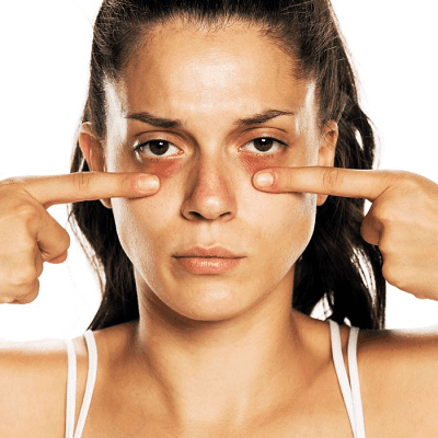 What Is The Best Treatment To Get Rid Of Dark Circles?