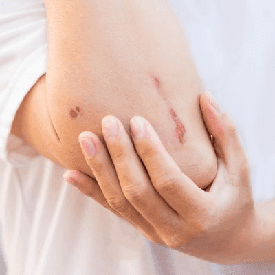 What Kinds of Scars can be Camouflaged? 1 What Kinds of Scars can be Camouflaged