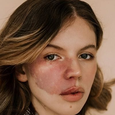 What Syndrome is Associated with Port Wine Stains? 1 What Syndrome is Associated with Port Wine Stains?