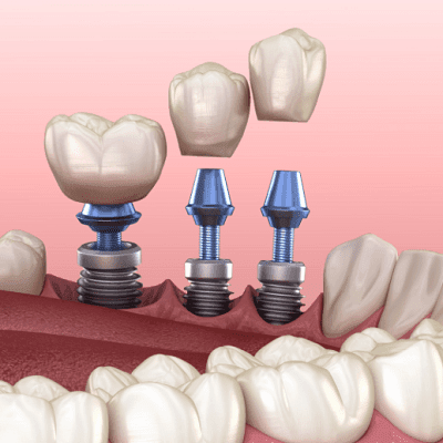 What To Expect During a Dental Implant Treatment?