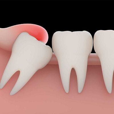 What To Expect During a Wisdom Tooth Extraction