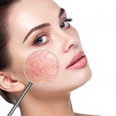 What Triggers Rosacea Flare-Ups and how to treat them?