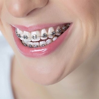 What are Metal Braces Used For? 1 What are Metal Braces Used For?