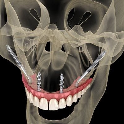What are Zygomatic Dental Implants