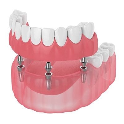 What are the 3 Types of Dental Implants? 1 What are the 3 Types of Dental Implants?