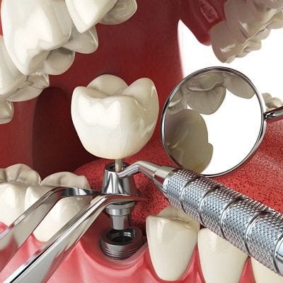 What are the Downsides of Dental Implants? 1 What are the Downsides of Dental Implants?