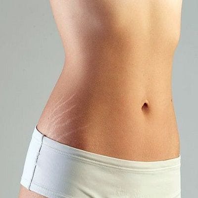 What are the Risks of Getting an Abdominoplasty