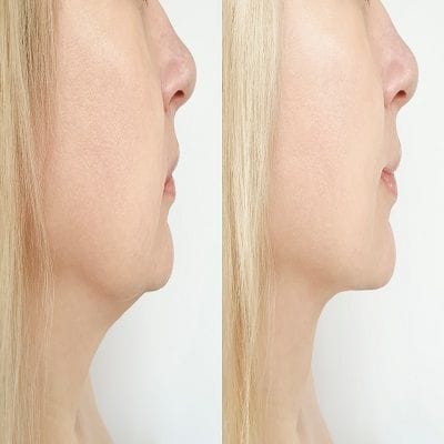 What Do You Know About Belkyra Treatment 1 What do you know about Belkyra Treatment