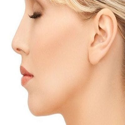 What do you know about alarplasty