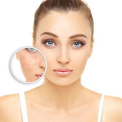 What is the Best Treatment for Acne Scars