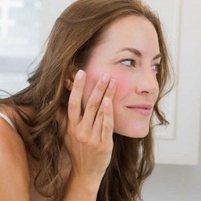 What is the Best Treatment for Rosacea in Dubai? 1 What is the Best Treatment for Rosacea in Dubai