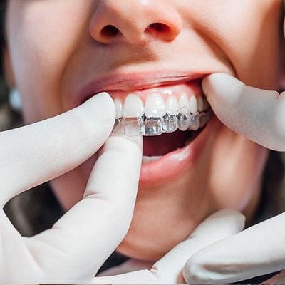 Which Teeth Aligners are the Best