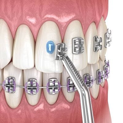 Which Type Of Braces Are The Best 1 Which Type Of Braces Are The Best
