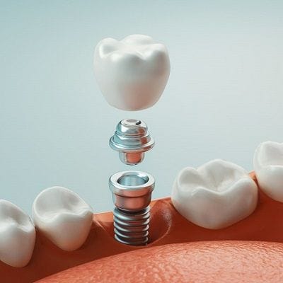 Who is Not Suitable for Dental Implants?