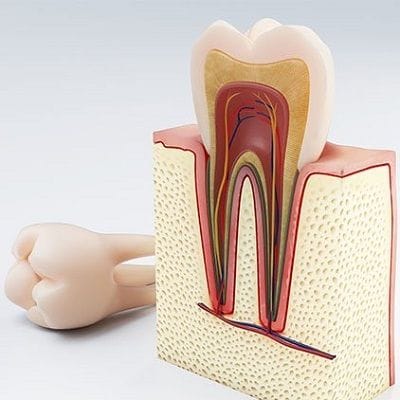 Why You Should Get a Root Canal