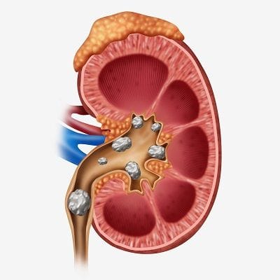 Why is Kidney Stone Removal Necessary? 1 Why is Kidney Stone Removal Necessary in Dubai?