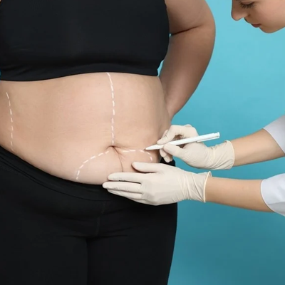 Will I Look Older After Bariatric Surgery 1 Will I Look Older After Bariatric Surgery?