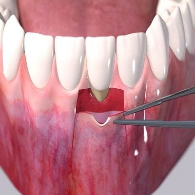 Will My Teeth Fall Out Receding Gums in Dubai