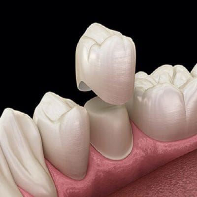 Zirconia Crown Cost in Dubai