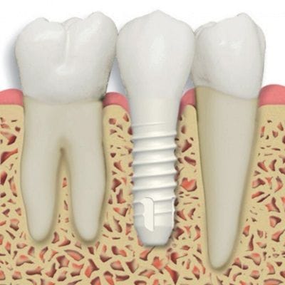 Zirconia Dental Implant in Dubai & Abu Dhabi Cost