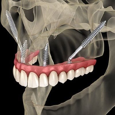Zygomatic Implants in Dubai, Abu Dhabi & Sharjah Dynamic Clinic