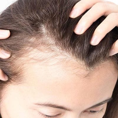 Is It Possible to Regrow Hair, According to an Expert? 1 Hair Loss Treatment Dubai