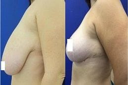 Breast Lift Surgery 4 breast-lift in dubai