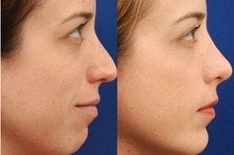 Chin Augmentation 8 best chin-augmentation in dubai