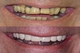 Full Mouth Dental Implants Cost 7 best-dental-implants-clinic-in-dubai