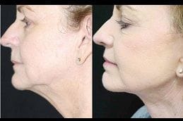 Double Chin Liposuction 4 best double-chin-liposuction in dubai