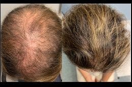 Hair Loss & Nail Disorders Treatment 3 hair-loss-nail-disorders-treatment in dubai