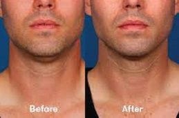 Kybella Treatment for Double Chin 12 best kybella-treatment-for-double-chin in dubai