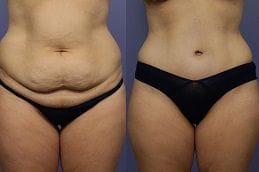 Lipo Abdominoplasty 4 best lipo-abdominoplasty in dubai