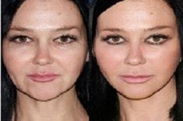 Magic Facelift 4 best magic-facelift in dubai