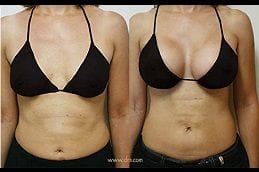 Motiva Breast Implants 4 motiva-breast-implants in dubai