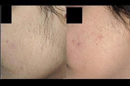 best non-invasive-hair-removal in dubai