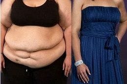 Post Weight Loss 5 best post-weight-loss in dubai