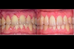 Soft Tissue Dental Laser 1 best soft-tissue-dental-laser in dubai