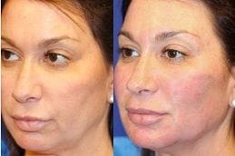 best vampire-facelift in dubai