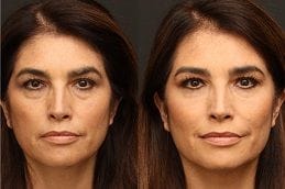 Botulinum Toxin Injections 4 botulinum-toxin in dubai