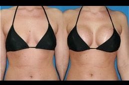BRAVA Breast Augmentation 4 brava-breast-augmentation in Abu Dhabi