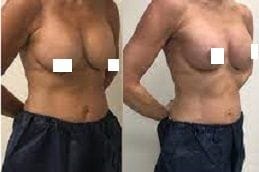 Breast Lift Surgery 5 breast-lift Clinic in Dubai
