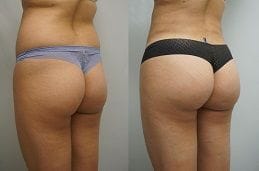Buttock Augmentation 4 buttock augmentation in dubai,abu dhabi & sharjah